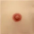 2cm Areola